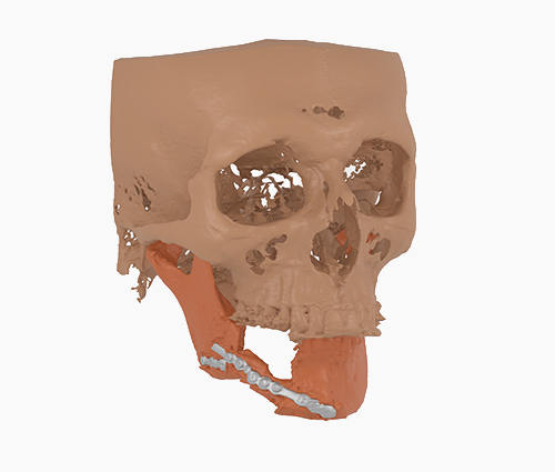 Virtual Surgery Planning (VSP)